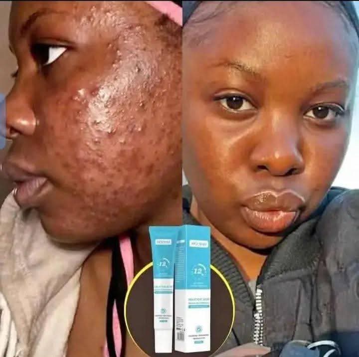 Gel anti-taches pour éliminer les imperfections, lisse la peau.