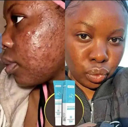 Gel anti-taches pour éliminer les imperfections, lisse la peau.